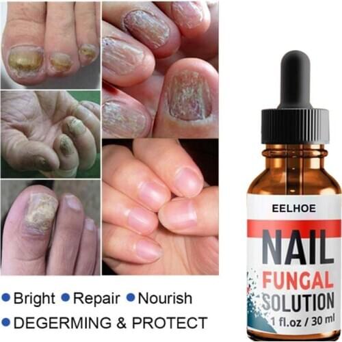 Nail Repair Liquid Essence-Serum Removal-Gel Healthy Care-Treatment Onychomycosis Foot-Nail-Fungus Toe Eliminate Gray 10/20/30ml