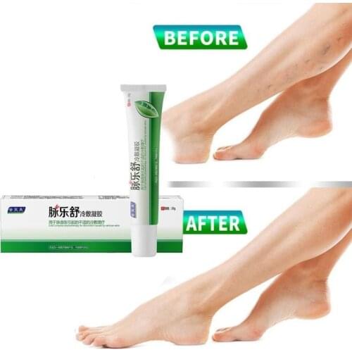 20g Varicose Vein Cream Pain Relief Varicose Veins Phlebitis Varicosity Angiitis Herbal Plaster Cream Spider Remedy Analges L3Z6