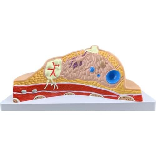 Breast lesion model breast anatomy model breast feeding training aids