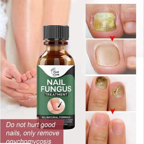 Fungal Nail Repair Essence Serum Care Treatment Toenail Fungus Removal Gel Repair Onychomycosis Fluid To Thicken Soft Nails