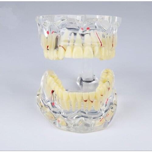 Oral adult pathology teaching model/ Dental pathology teeth model M4001/ Dental orthodontic treatment model