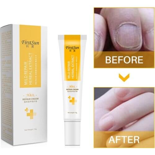 Herb Nail Care Nail Repair Cream Onychomycosis Paronychia Treatment Nail Podiatry Anti Fungus Nail Toe Repair Cream