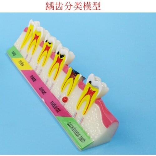 Human Tooth Anatomical Model Dental Caries Anatomical Model Caries Anatomy Human Oral Teaching Models Tooth Pathology Model