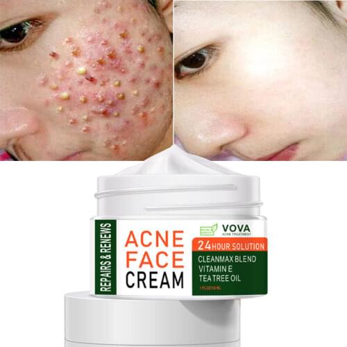 Effective Acne Removal Cream Acne Treatment Fade Acne Spots Oil Control Shrink Pores Whitening Moisturizing Acne Cream Skin Care