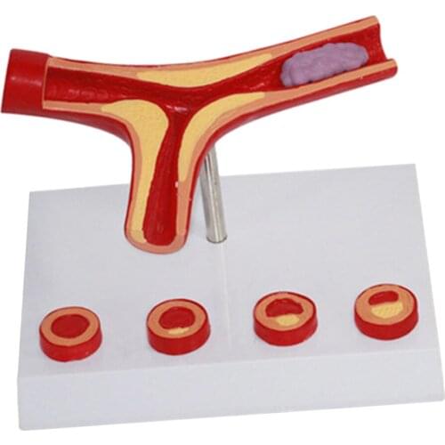 Human Vessel Anatomical Model Atherosclerosis Model for Medical Training Model