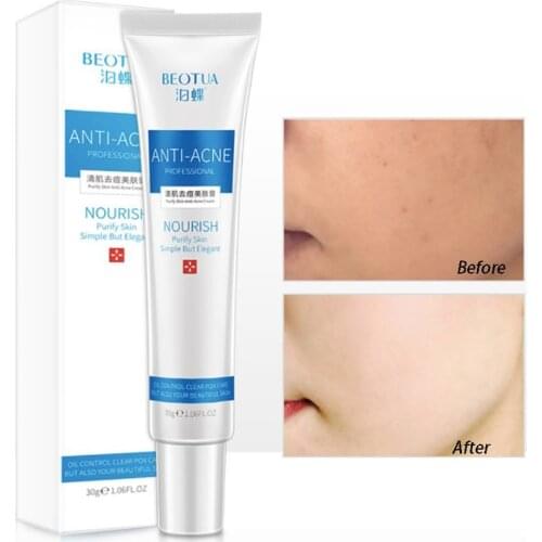 Plant Acido Hialuronico Dark Spot Pimple Remover Melasma For Face Cream Acne Crema Hidratante Crema Para La Cara Skin Care Sets