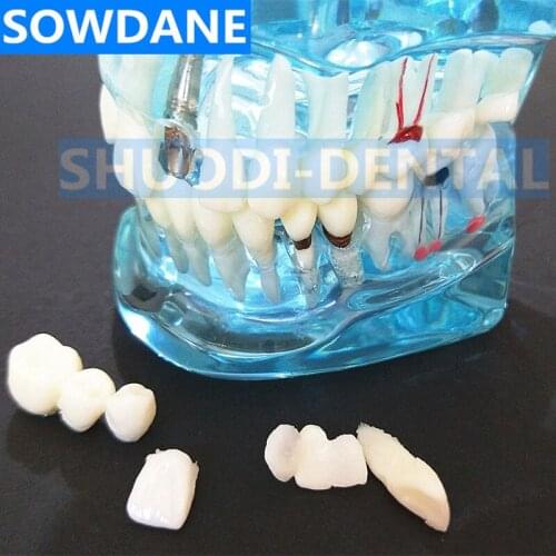 Hot Dental Implant Disease Teeth Model With Restoration Bridge Tooth Dentist For Medical Science Dental Disease Teaching Study