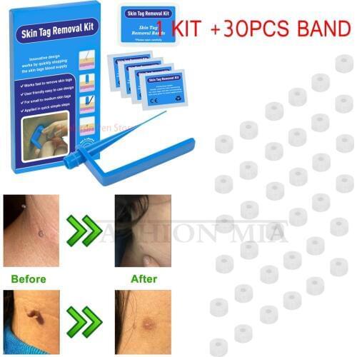 Micro skin tag remover Kit quita verrugas face mole Wart removal Micro Band skin tag remove patch For Small To Medium skin tag
