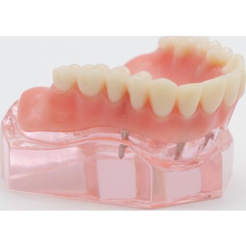 Dentist Overdenture Upper Anterior Maxillary 4 Implants Restoration Teeth Model For Dentistry Lab