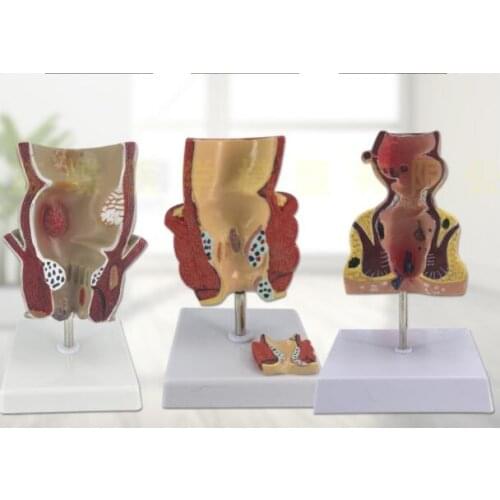 Rectal acne lesion model acne internal and external anatomy anal anorectal colorectal pathology model