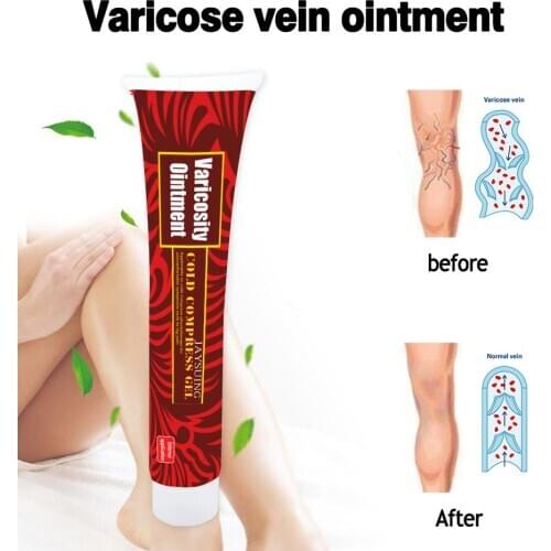Pain Varicosity Angiitis Ointment Varicose Veins Symptoms Pain Nodules Acidity Numbness Treatment Cream Health Care