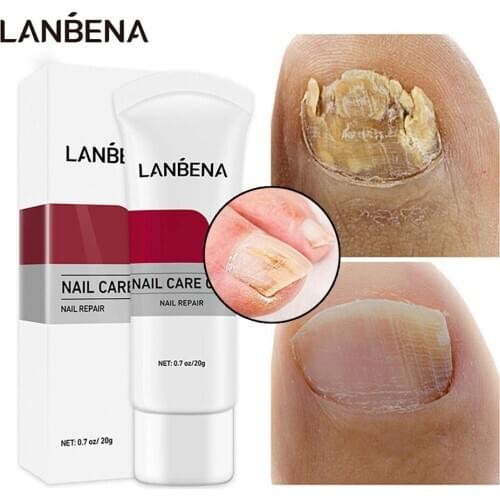 LANBENA Nail Fungus Removal Cream Onychomycosis Fungal Nail Treatment Paronychia Anti Infection Feet Toe Fungal Nail Care Gel