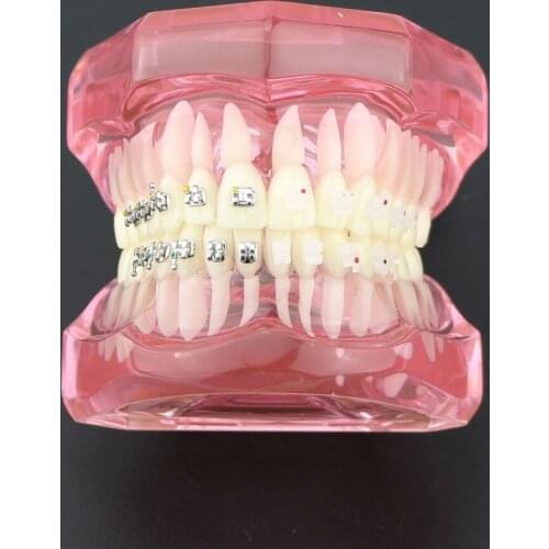 Dental Orthodontic Model with Metal and Ceramic Brackets 3003 Pink Dental Teeth Study Model