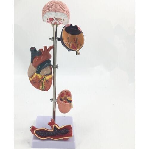 Pathological model of hypertension，Heart vessel model，Blood pressure vascular model