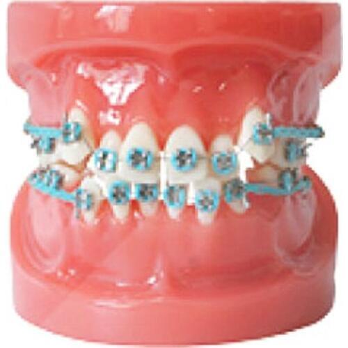 Dental Orthodontic Model with Metal and Ceramic Brackets Dental Teeth Study Model Half Metal half Ceramic