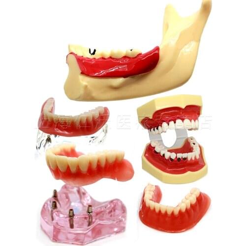 Dental education model teeth planting repair explanation teaching dental mold pathology oral model
