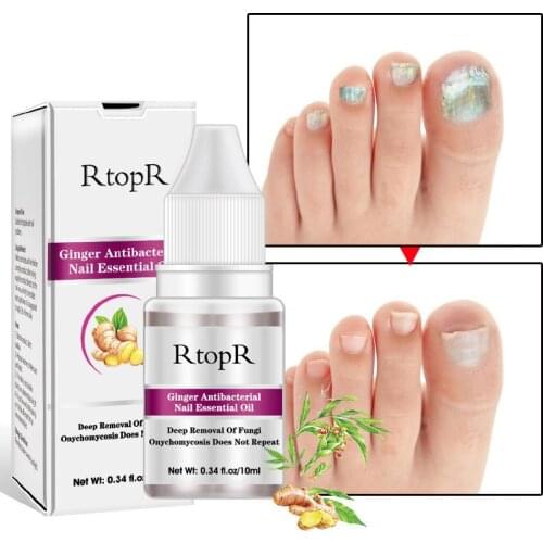 10ml Leuconychia Treatment Powerful Anti-fungal Herbal Plants Extract Nail Care Solution Gel Fingernails Toenails Care Tool