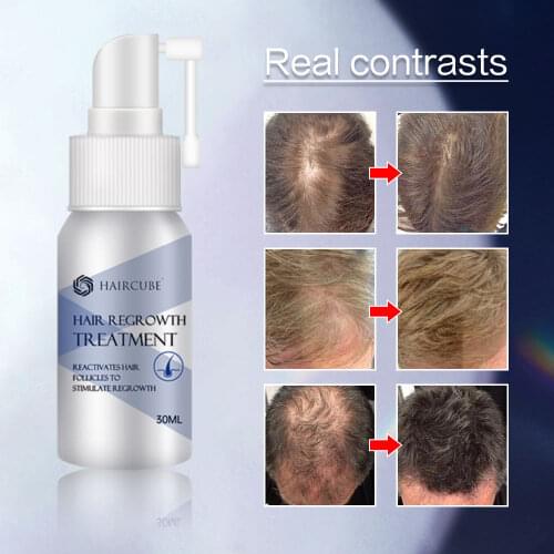 Hair Rapid Growth Spray for Mens Treatment Hair Loss Natural Herbal Health Hair Growth Longer and Thicker Hair Care Products