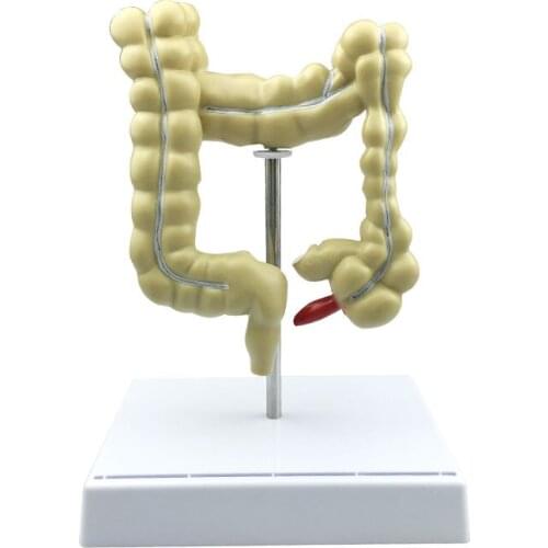 Colorectal Lesion Model Human Colon Large Intestine Pathological Diseases Model Medical Mrganizer Anatomy