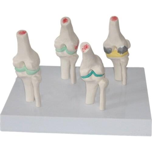Deflate Version knee model 4 stage different symptoms Knee joint lesion model