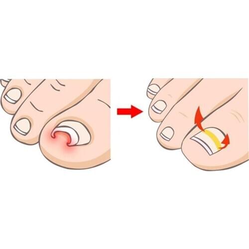 NEW 10pcs/pack Ingrown Toe Nail Correction Sticker Patch Paronychia Correction File Acronyx Wire Corrector Foot Care Treatment