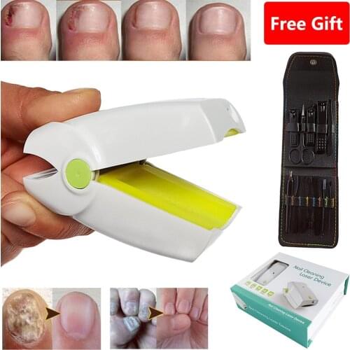 Nail Fungal Cleaning Laser Device Nail Fungus Treatment Nail Fungus Infection Remover Yellow Fungi Solution