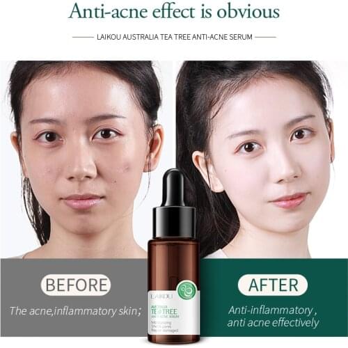LAIKOU Tea Tree Acne Treatment Face Serum Whitening Moisturizing Oil-control Anti-Aging Essence Anti Acne Anti Scar Skin Care