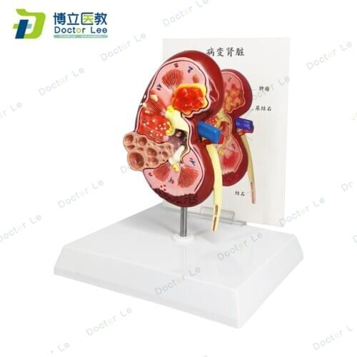 Nature size kidney diseased model anatomical anatomy diseasd pathological stone organ for medical science teaching