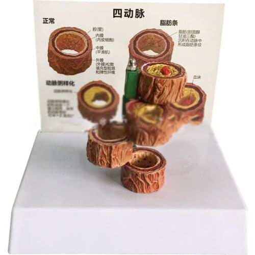 Human artery atherosclerosis model thrombosis vascular model hematology arteriosclerosis model