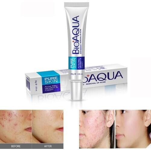 Effective Acne Removal Cream Acne Treatment Fade Acne Spots Oil Control Shrink Pores Whitening Moisturizing Acne Cream Skin Care