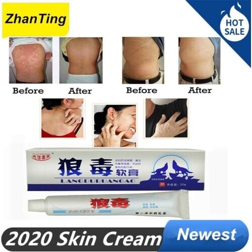 ZhanTing 3 Pcs / Natural Chinese Herbs Herbal Psoriasis Dermatitis Treatment Cream Anti Bacterial Skin Fungus Candida Albicans