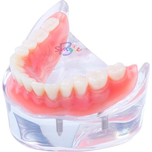 High quality Dental Teaching Study Overdenture Teeth Model Removable Interior Mandibular Lower Teeth Model