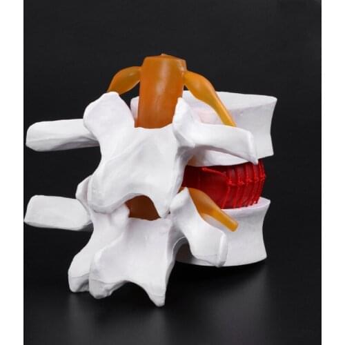 Human Anatomical Lumbar Disc Herniation Model Learn Aid Anatomy Instrume K5DB
