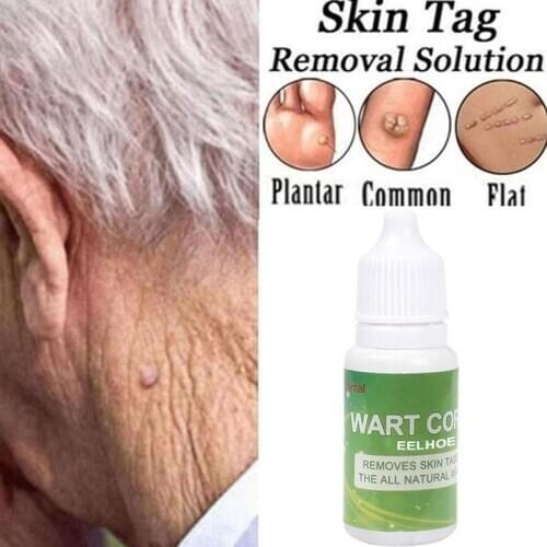 10ml Skin Tags Removing Against Moles Remover Wart Skin Mole Removal Liuld Genital Wart Treatment Papillomas Removal