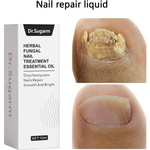Nail repair solution treatment with files to remove nail toe fungus, nails nourishment brighten and X2D8