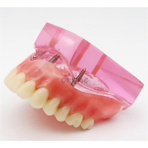 1pcs Dental Upper - 4 Implant Implant Restoration Model With 4 Planting Nails Student Learning Teaching Model