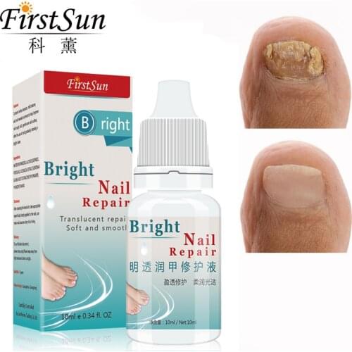 Fungal Nail Treatment Essence Foot Toe Nail Fungus Removal Whitening Feet Nail Gel Tools Onychomycosis Treatment Nail Care 10ml