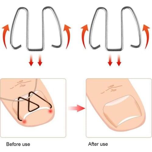 Nail Art Ingrown Toe Nail Correction Tool Toenail Nail Ingrown Clip Orthosis Paronychia Pedicure Foot Tool Corrector