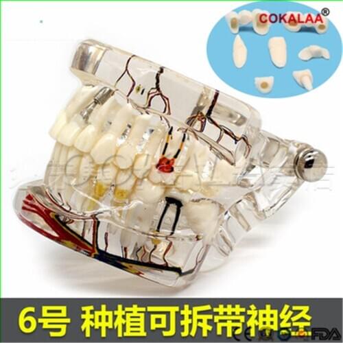 Dental teeth model Transparent pathological implant nerve model Repair model Teaching demonstration model