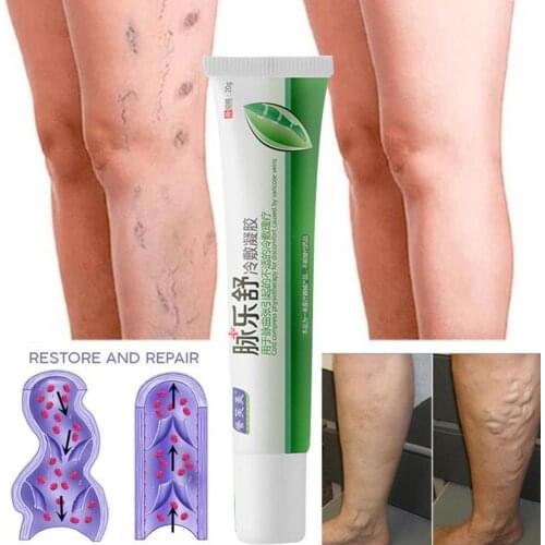 1pc 20g Varicose Vein Cold Compress Gel Phlebitis Vasculitis Swelling Relief Leg Pain Treatment Angiitis Care Varicosity Oint