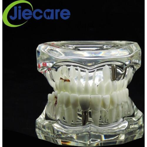 1 PC Hot Sale Dental Study Tooth Transparent Adult Pathological Teeth Model For Dental Adult Teaching Study Dentist Materials
