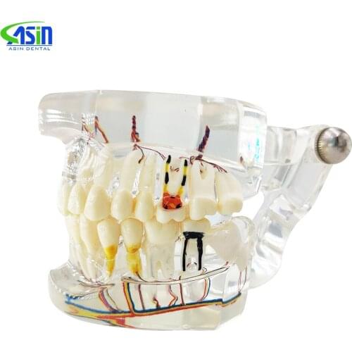 Dental Teaching Teeth Model Implant with Nerve Transparent Pathological Repair Teaching demonstration model