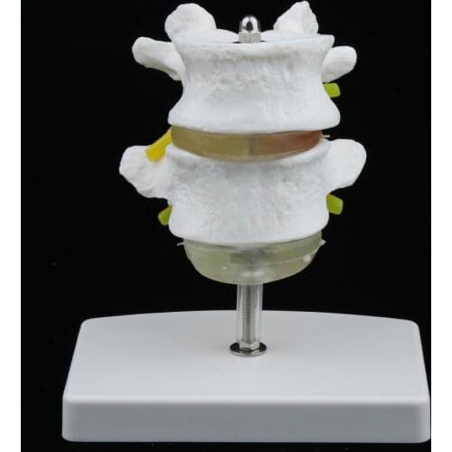 16*9*8cm Lumbar Set (2 pcs) lumbar disc herniation demonstration model,Human lumbar model medical teaching model