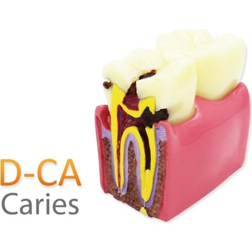 D-CA Teeth Model Dentist student Model for Teaching Dentist Tools Dental Lab Model Caries 6 times tooth