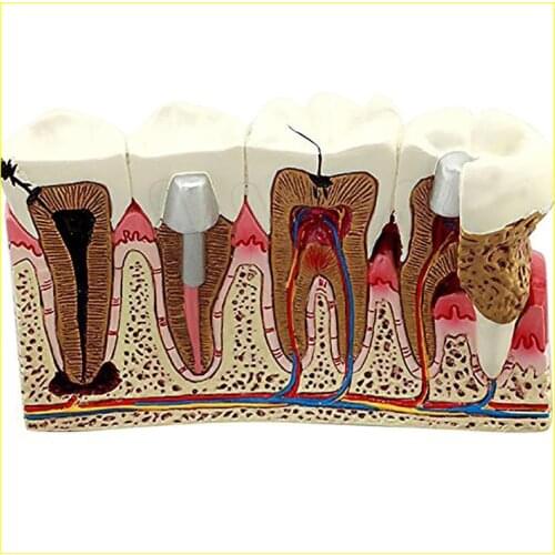 Dental Caries anatomy tooth Model Caries anatomy model Teaching&study