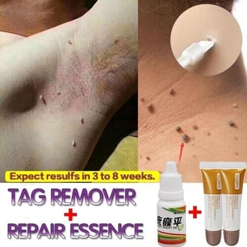 Skin Tag Remover Bacteriostatic Liquid 10 ml Medical Genital Wart Treatment Repair Serum Anti Foot Corn Moles fast Removal
