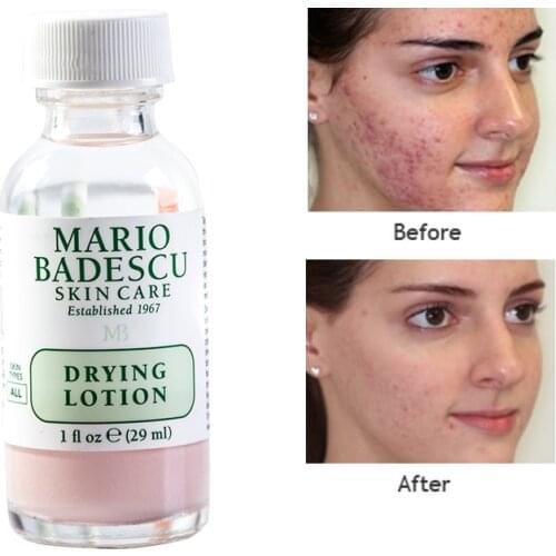 29ml An Effective Acne Treatment Original Mario Badescu Drying Lotion Anti Acne Serum Pimple Blemish Removal Skin Care