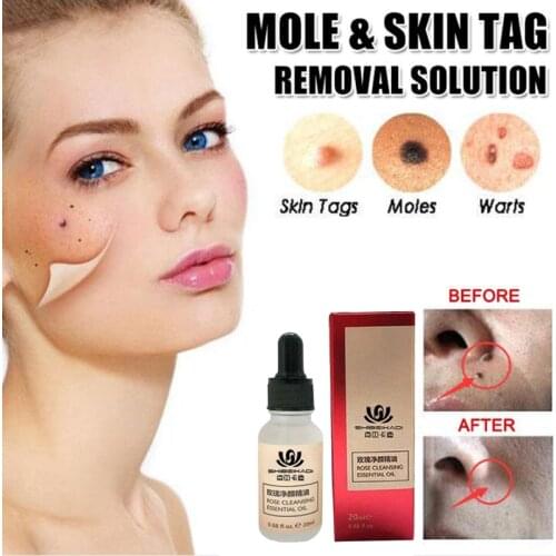 Mole & Skin Tag Removal Solution Painless Mole Skin Dark Spot Removal Face Wart Tag Freckle Removal Cream Oil Plaster