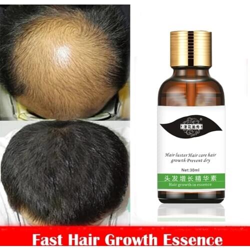 Lanthome Hair Loss Remedies