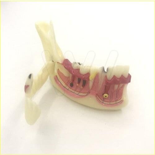 Orthodontic Braces Dental Mandibular Tissue Teeth Demonstration Anatomical Model Patient Study Teach Model